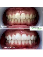 ホワイトニングサロン 名古屋駅店/【ホワイトニング施術例】