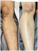 ルーメ(lume)/脱毛40代男性