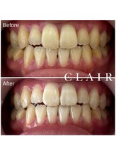 クレア(Clair)/セルフホワイトニング ¥1,100 