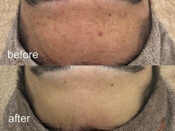 エムフロート(M float)/ハーブピーリング|ニキビ