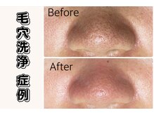 ザ ピーチ(THE PEACH)/いちご鼻解消！ニキビ予防にも！