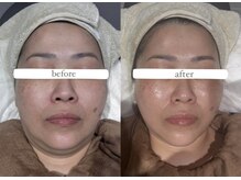 ラヴィン なんばスカイオ店(Lovin)/【カーボキシー炭酸マスク】