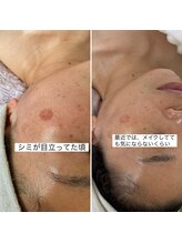 リュミエール(Lumie're)/シミ改善
