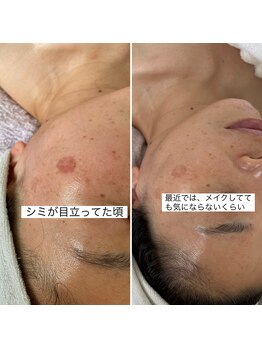 リュミエール(Lumie're)/シミ改善