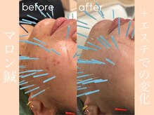 健志接骨院/マロン鍼+πテラピーでの変化