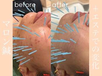 健志接骨院/マロン鍼+πテラピーでの変化