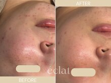 エクラ(eclat)/頑固な跡もしっかり変化！