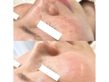箔屋(hakuya)の写真/幹細胞で生まれ変わる肌へ。結果重視のエイジングケアでハリ、シミをケア◎
