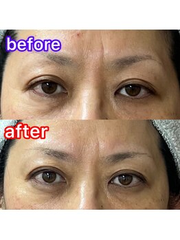 シュシュ(chouchou)/フェイシャル/ビフォーアフター