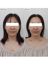 ヴェルシック(Belchic)/頬の脂肪を減らしてむくみも解消