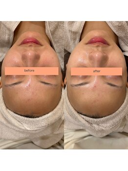 サクラ スパ(SAKURA SPA)/毛穴リメイクコース