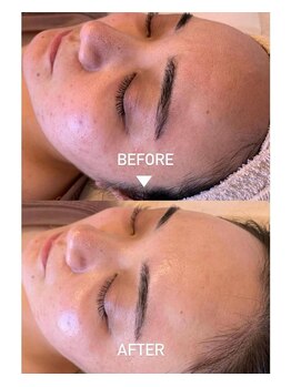 エイティ(Atey)/ハイドロ