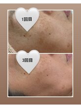 アイラッシュ バイ ポジャ(EYELASH by Poja)/復元パック／磁気パック