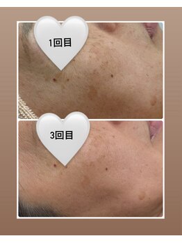 アイラッシュ バイ ポジャ(EYELASH by Poja)/復元パック／磁気パック