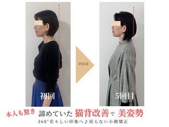 エソア(esoa)/50代 小顔矯正
