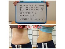 EMSマシン と骨盤矯正を組み合わせることで痩身も叶う！