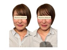 ハリトト鍼灸院の雰囲気（初回￥6,600～ 小顔/むくみ/肌ケア/リフトアップ/食いしばりケア）