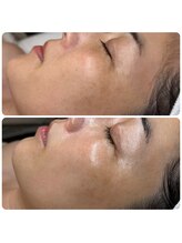 エミレーブ シロカネ(Hemireve Shirokane)/高保湿トリートメントで小皺ケア