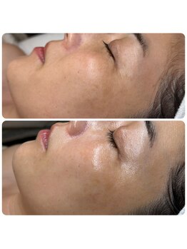 エミレーブ シロカネ(Hemireve Shirokane)/高保湿トリートメントで小皺ケア