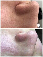 ヒルナム(Heal Nam)/毛穴エクストラクション