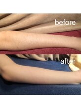 ナナラ(nanala)/腕脱毛効果