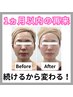【2回目】《Haririna式》美顔鍼+フェイシャルエステ〈70分〉¥15,400→