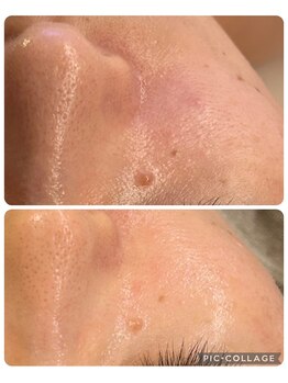 ルピナージュ(Lupinage)/【肌質改善】‐しみケア‐