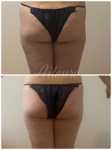 エルール トータルビューティ(Aileure total beauty)/インディバ痩身