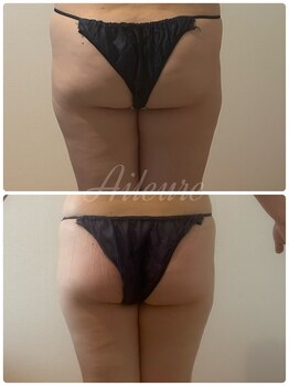 エルール トータルビューティ(Aileure total beauty)/インディバ痩身