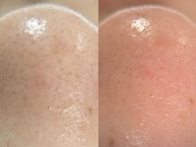 フェリス(FELIZ)/毛穴洗浄で黒ずみケア