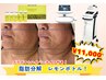 【8月限定】プラズマ+ハイパーナイフ+脂肪分解剤レモンボトルで即小顔へ！