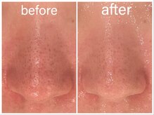 エステティックサロン ベルエトワール住吉店/ハイドロ毛穴洗浄