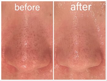 エステティックサロン ベルエトワール住吉店/ハイドロ毛穴洗浄