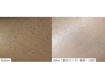 アレイズ(ARAYS)/症例(脱毛)