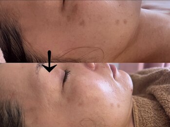 サロン ドロップ 上小田井(Salon drop)/「シミ改善」