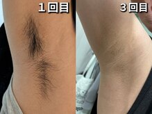 プロジェクトサン ムーンベル(PROjECTSuN Moonbell)/小学生　脱毛　ワキ