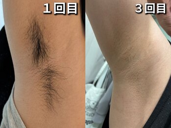 プロジェクトサン ムーンベル(PROjECTSuN Moonbell)/小学生 脱毛 ワキ