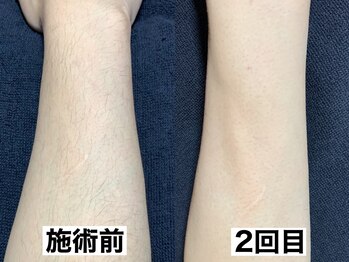 エモーショナル 姫路(Emotional)/腕脱毛2回の変化【メンズ脱毛】