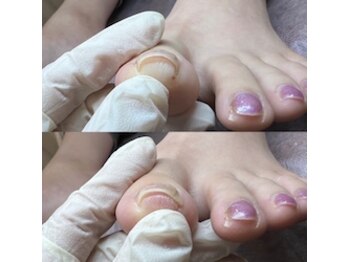 白岡総合整骨院 整体院/巻き爪