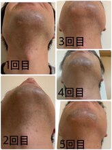 長寿鍼灸院 長寿整骨院/毎日の髭剃りが面倒くさい方へ★