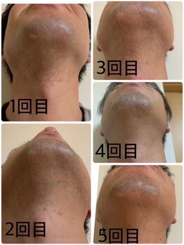 長寿鍼灸院 長寿整骨院/毎日の髭剃りが面倒くさい方へ★