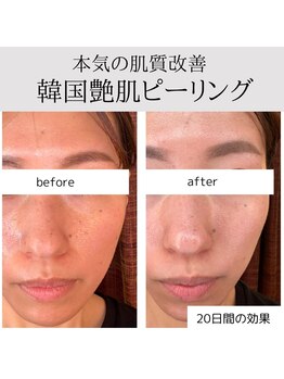 ルナビューティー(LUNA BEAUTY)の写真/話題の［韓国艶肌ラレステン］導入店！独自のピーリング術で透輝の艶肌♪お肌に優しい天然成分で素肌美人に