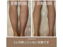 ユニセックスサロン アンシェル(UNISEXSALON UNCHEL)/【メンズ脱毛人気No.2】足脱毛