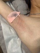 トリプルワン(111)/メンズボディWAX脱毛