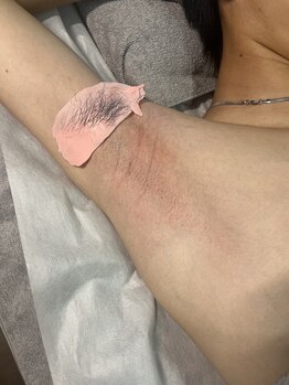 トリプルワン(111)/メンズボディWAX脱毛