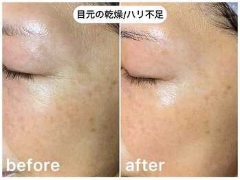 フラックス 京都(FLUX)/【エンビロン】乾燥ケアコース