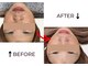 ベガ(Vega)の写真/【夏の毛穴対策】開き・黒ずみを根本改善!大人気ハーブピーリングで至近距離でも自信が持てる陶器肌へ♪