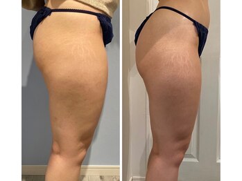 ルナグランデ(Luna grande.)/脂肪を分解して細く