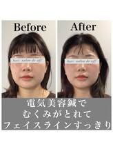 ハリサロンドオフ 心斎橋店(hari salon de off)/電気美容鍼でむくみ改善☆