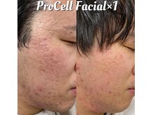 叶(Kanau)/プロセルセラピーズ